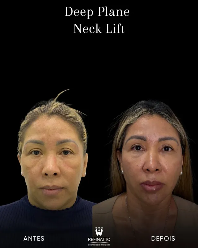 Before and after deep plane facelift — -1-year-old patient, frontal view by Dr. Danillo Marinho