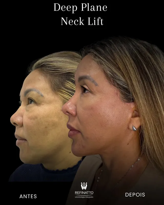 Before and after deep plane facelift — -1-year-old patient, frontal view by Dr. Danillo Marinho