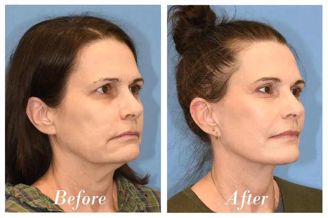 Before and after deep plane facelift — 48-year-old woman, three-quarter view, 6mo post-op by Dr. Danny Soares