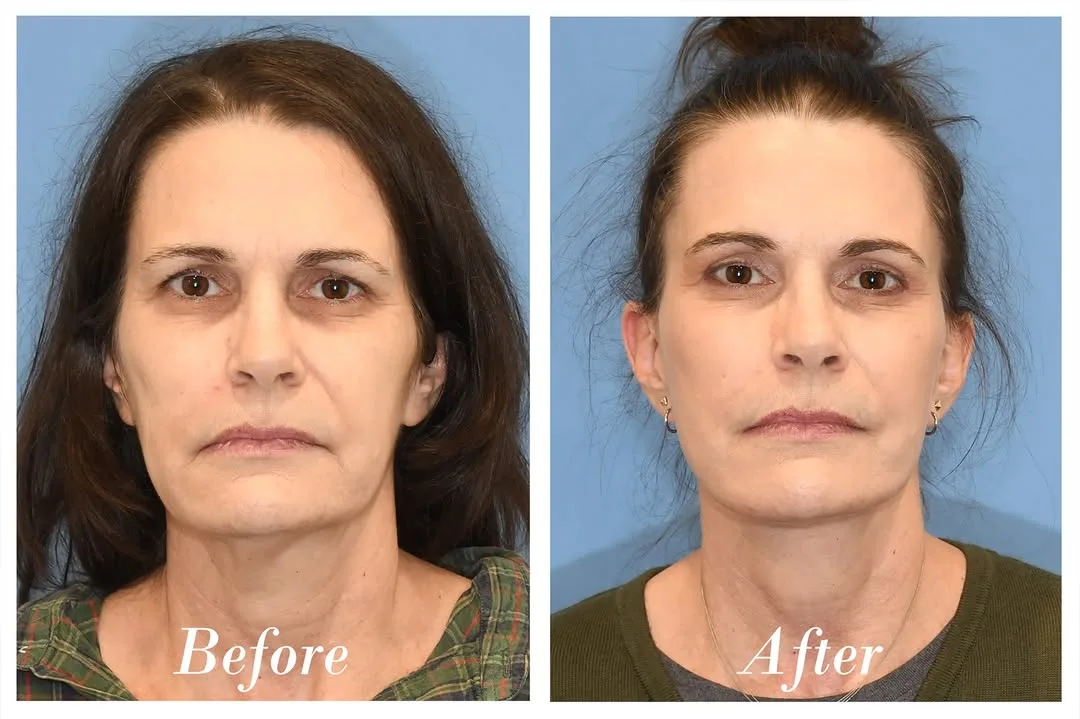 Before and after deep plane facelift — 48-year-old woman, frontal view, 6mo post-op by Dr. Danny Soares