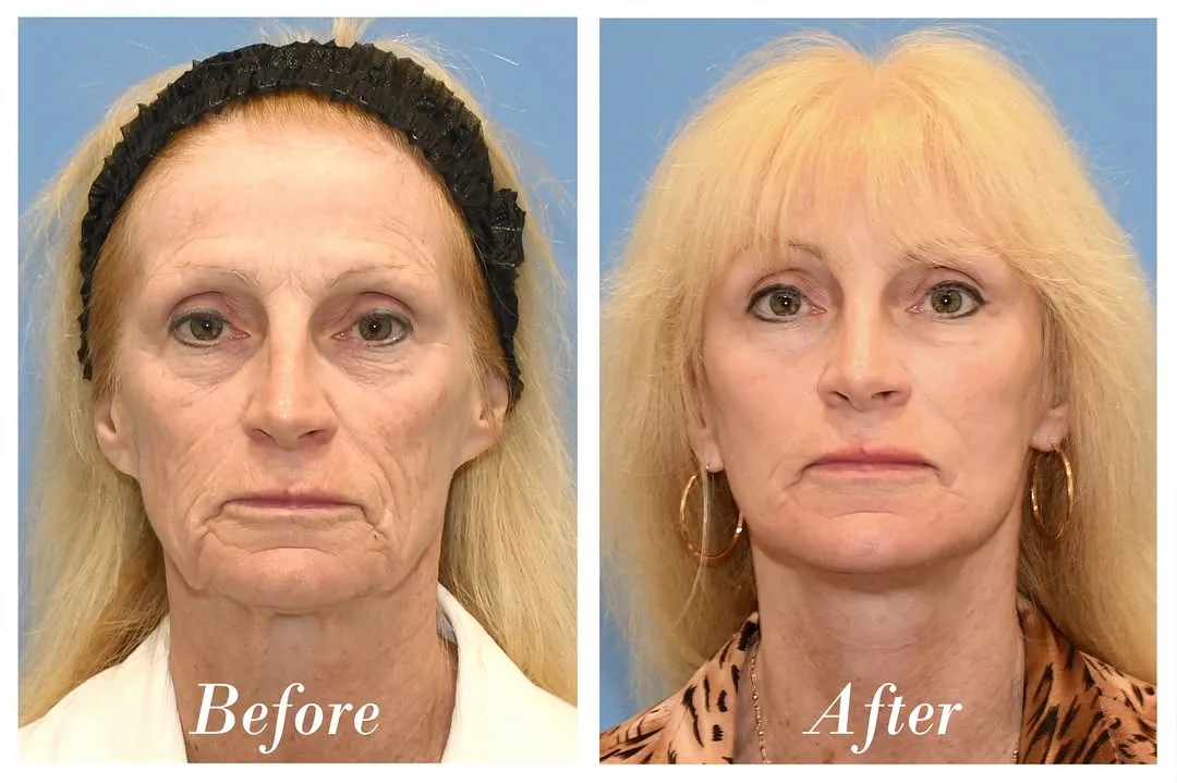 Before and after deep plane facelift — 58-year-old woman, frontal view, 7mo post-op by Dr. Danny Soares