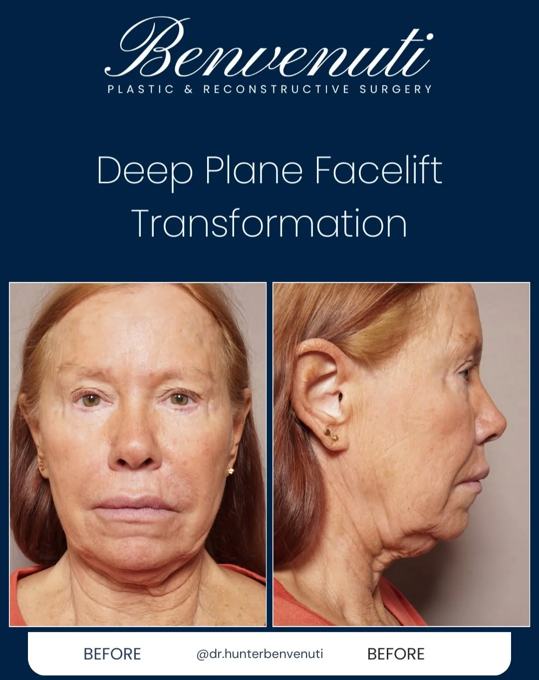 Before and after deep plane facelift — 69-year-old woman, right profile view, 7mo post-op by Dr. David Benvenuti