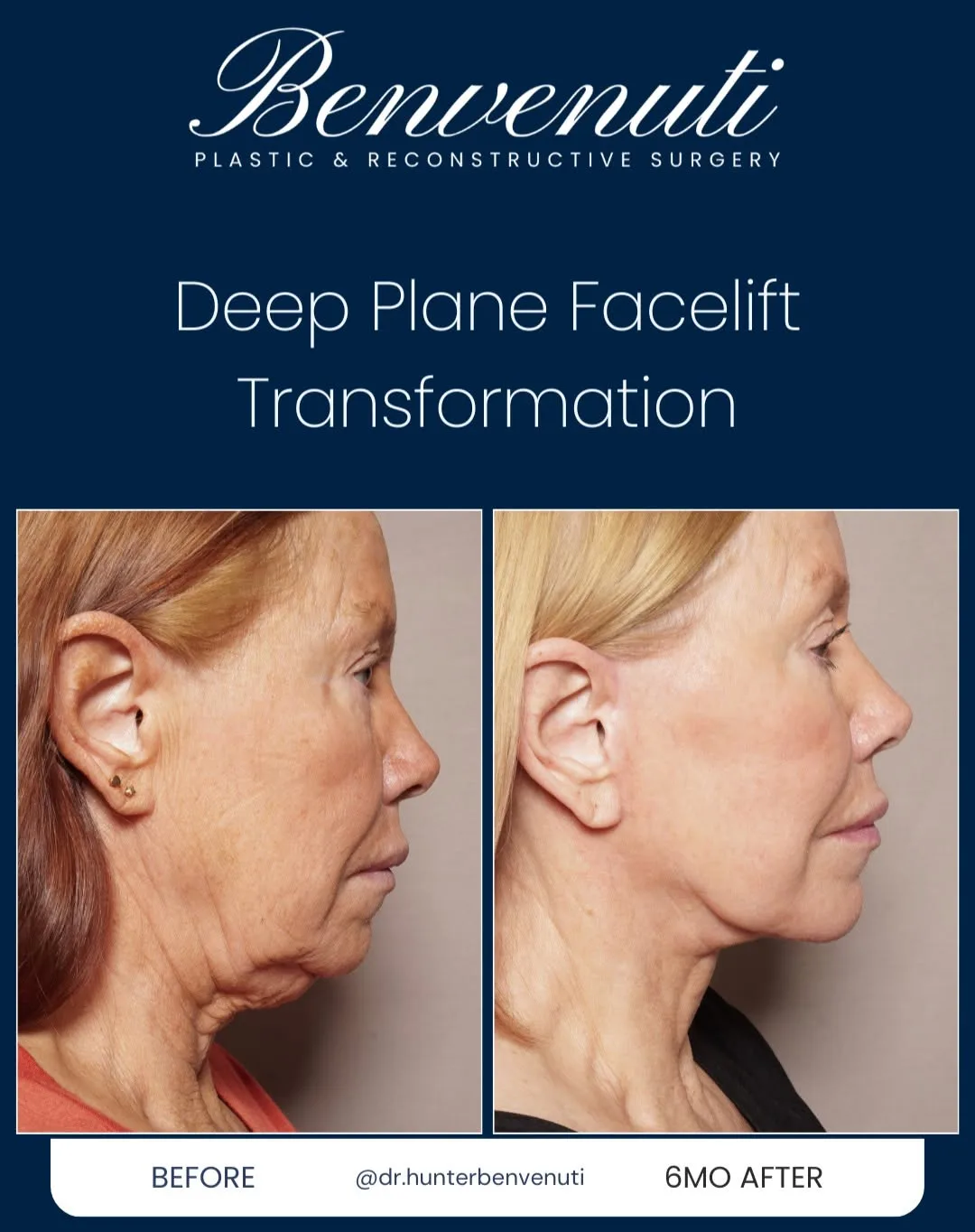 Before and after deep plane facelift — 69-year-old woman, right profile view, 6mo post-op by Dr. David Benvenuti