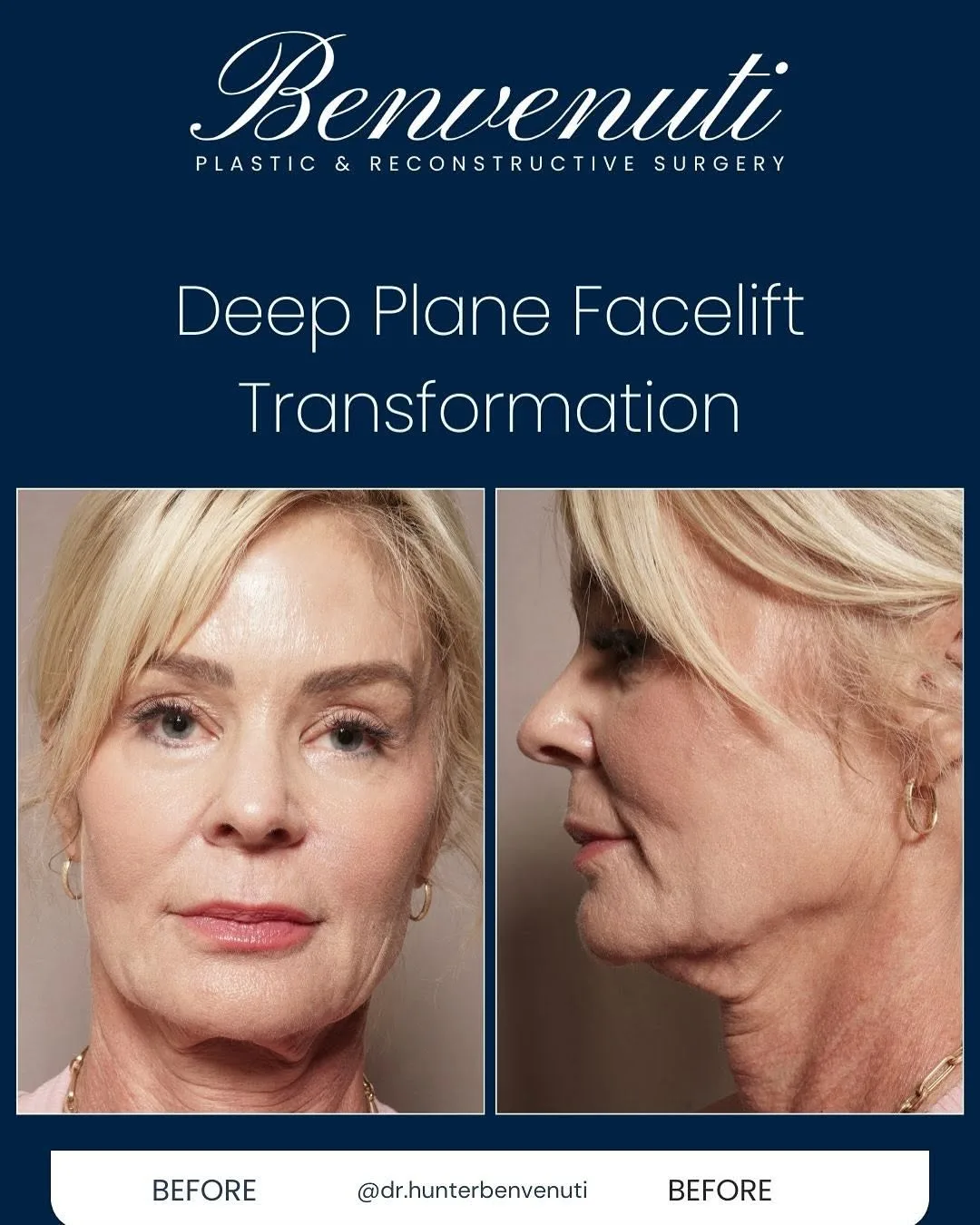 Before and after deep plane facelift — 58-year-old woman, right profile view, 12mo post-op by Dr. David Benvenuti