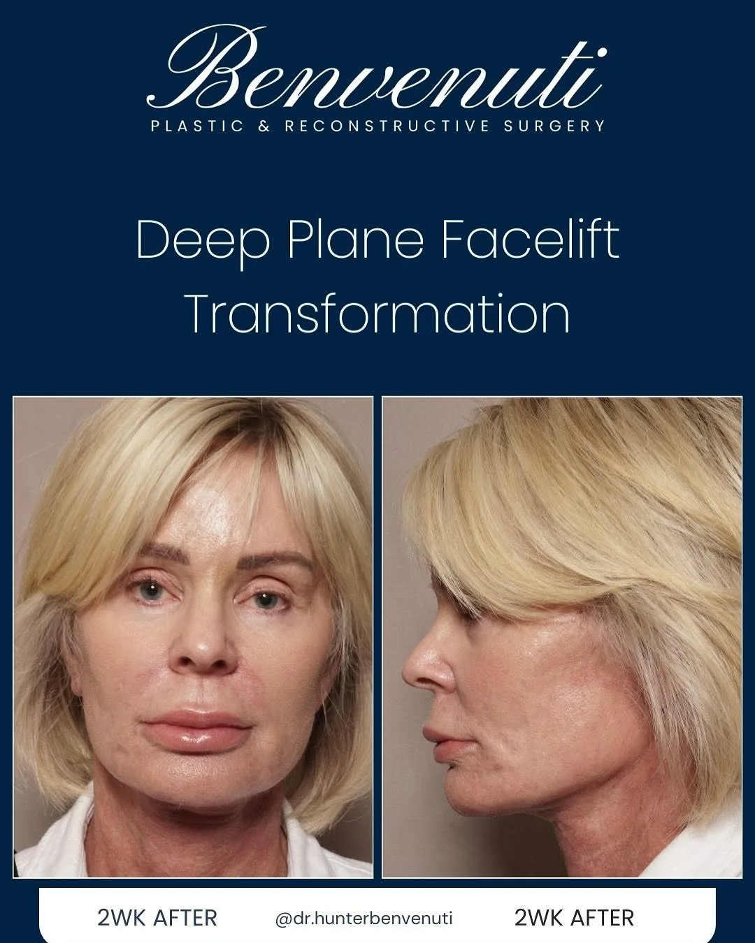 Before and after deep plane facelift — 58-year-old woman, frontal view, 2mo post-op by Dr. David Benvenuti