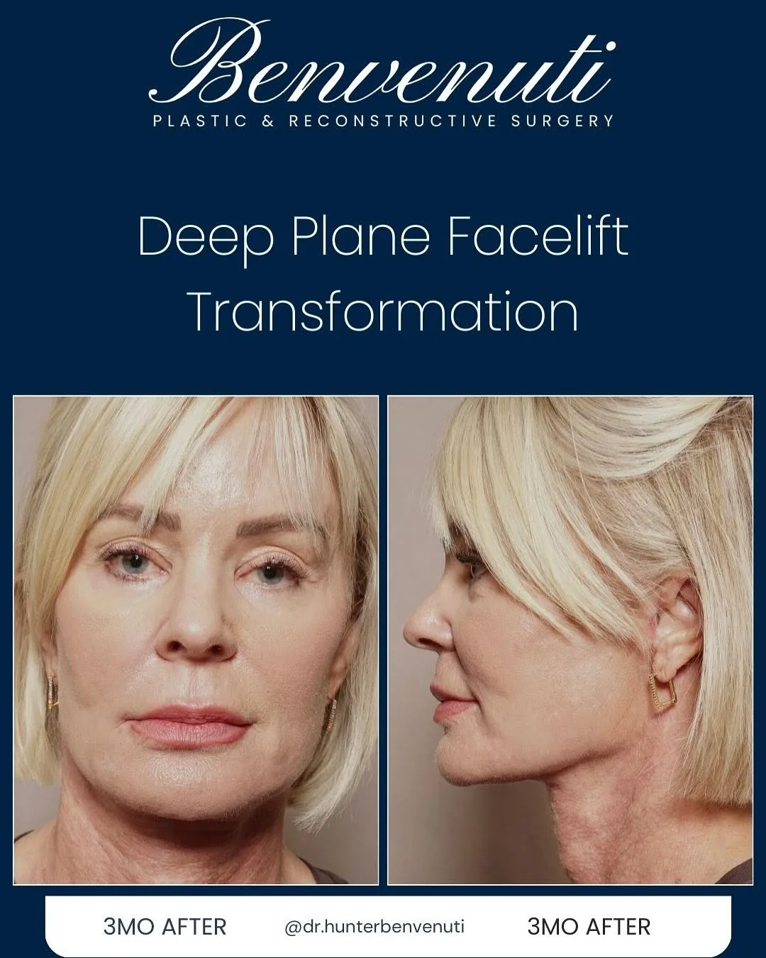 Before and after deep plane facelift — 58-year-old woman, oblique left view, 3mo post-op by Dr. David Benvenuti