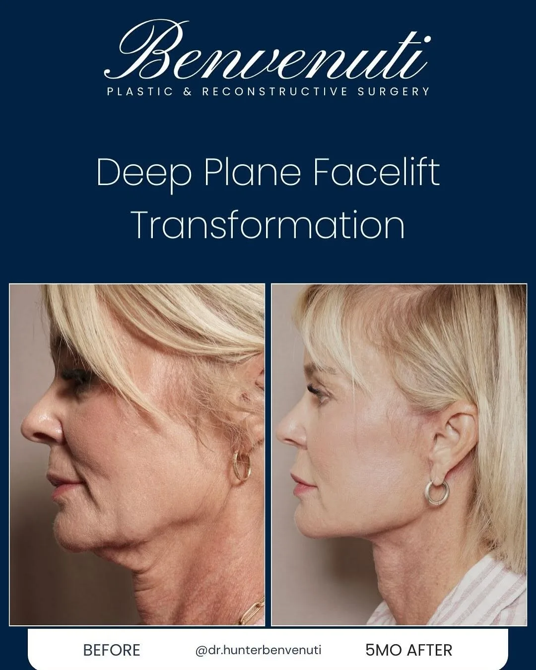 Before and after deep plane facelift — 58-year-old woman, right profile view, 5mo post-op by Dr. David Benvenuti