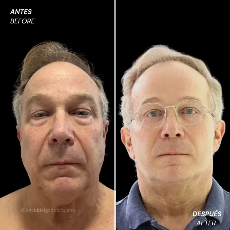 Before and after deep plane facelift — 65-year-old man, frontal view by Dr. David Delgado