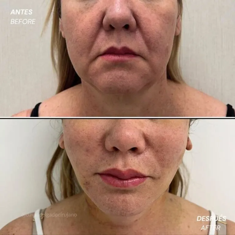 Before and after deep plane facelift — 55-year-old woman, frontal view by Dr. David Delgado