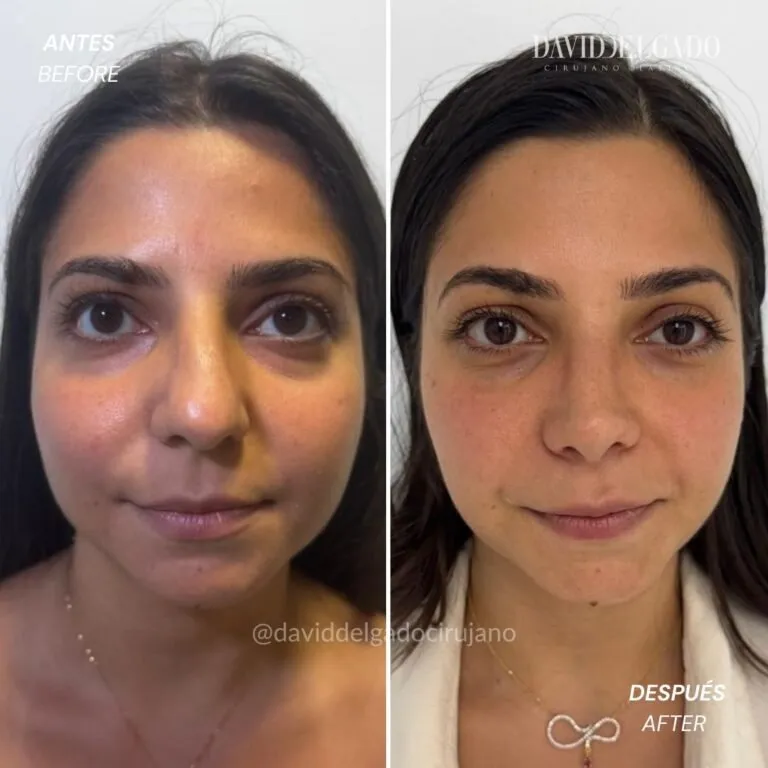 Before and after deep plane facelift — -1-year-old patient, frontal view by Dr. David Delgado