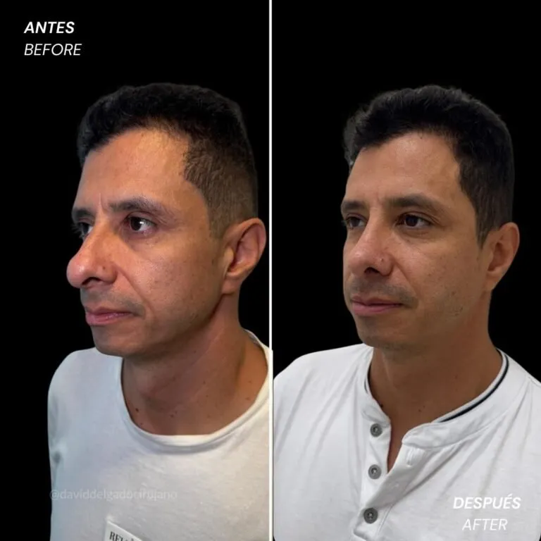 Before and after deep plane facelift — 45-year-old man, frontal view by Dr. David Delgado