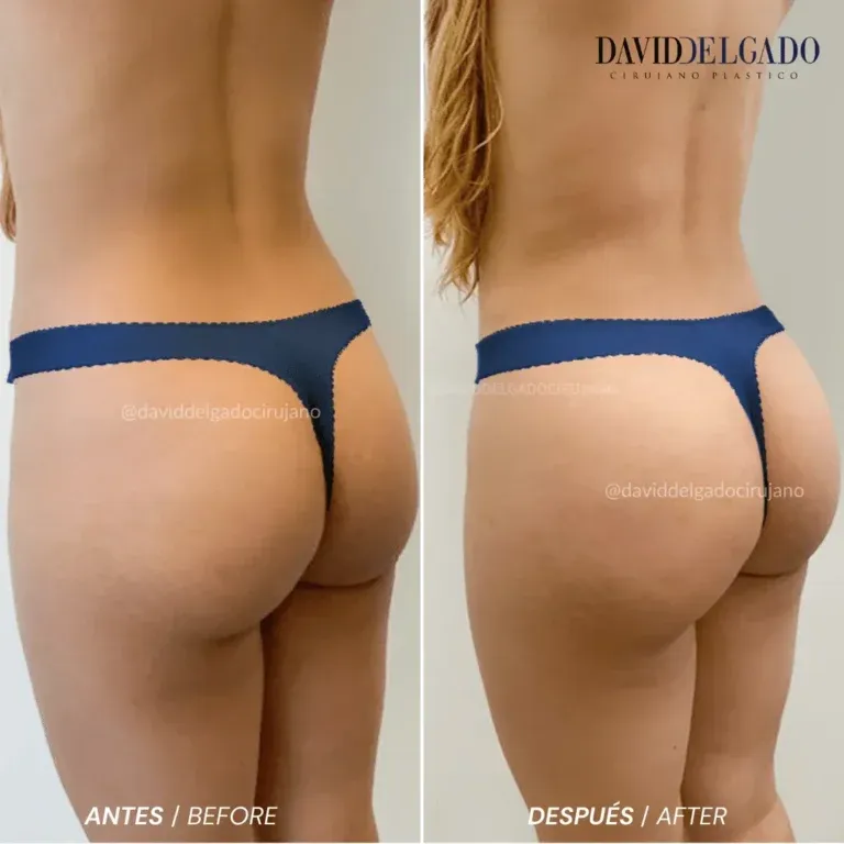 Before and after deep plane facelift — woman, frontal view by Dr. David Delgado