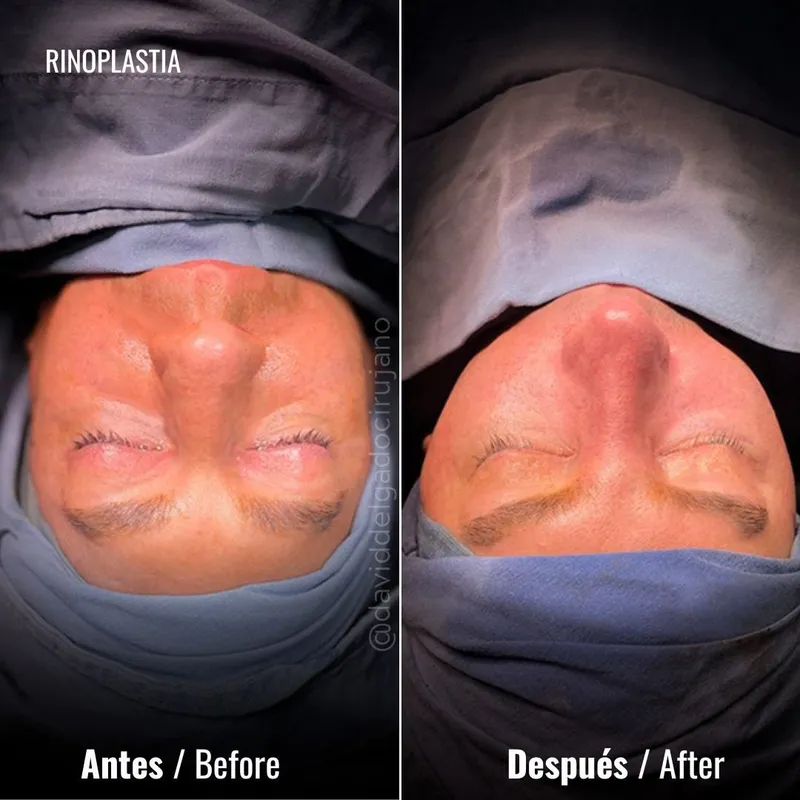Before and after deep plane facelift — -1-year-old patient, frontal view by Dr. David Delgado