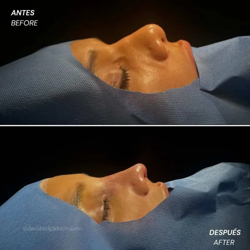 Before and after deep plane facelift — 35-year-old woman, frontal view by Dr. David Delgado