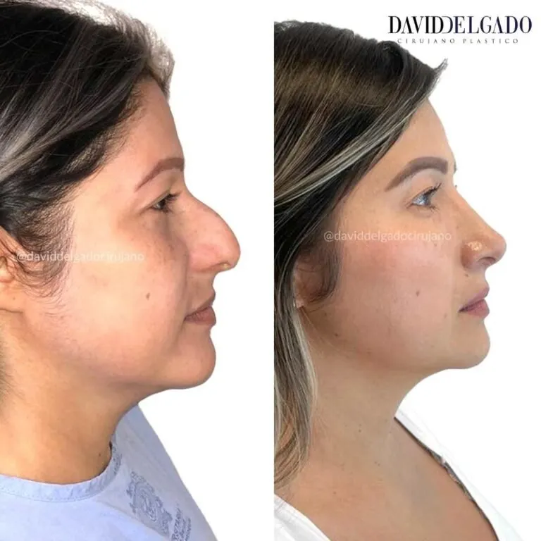 Before and after deep plane facelift — 45-year-old woman, frontal view by Dr. David Delgado