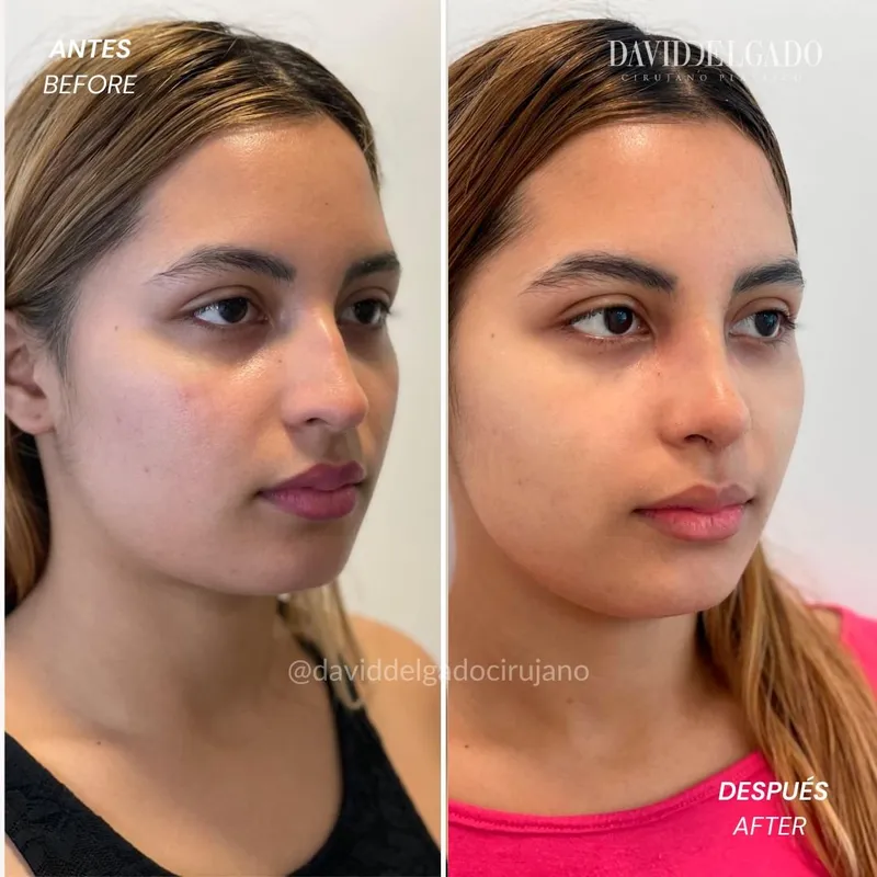 Before and after deep plane facelift — -1-year-old patient, frontal view by Dr. David Delgado