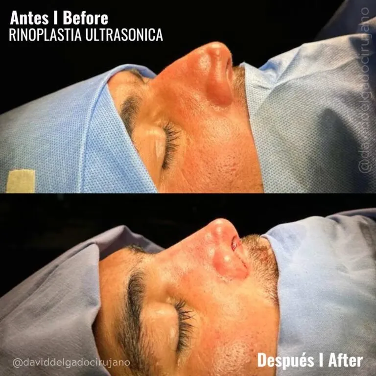 Before and after deep plane facelift — -1-year-old patient, frontal view by Dr. David Delgado