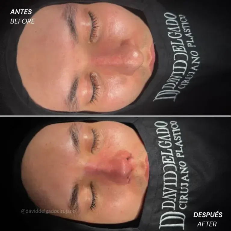 Before and after deep plane facelift — -1-year-old patient, frontal view by Dr. David Delgado