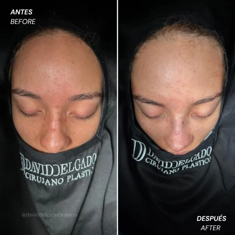 Before and after deep plane facelift — -1-year-old patient, frontal view by Dr. David Delgado