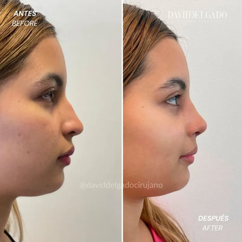 Before and after deep plane facelift — -1-year-old patient, frontal view by Dr. David Delgado