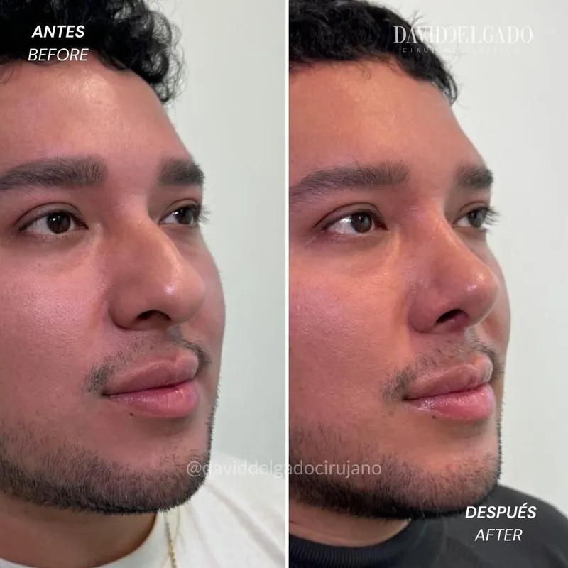 Before and after deep plane facelift — -1-year-old patient, frontal view by Dr. David Delgado