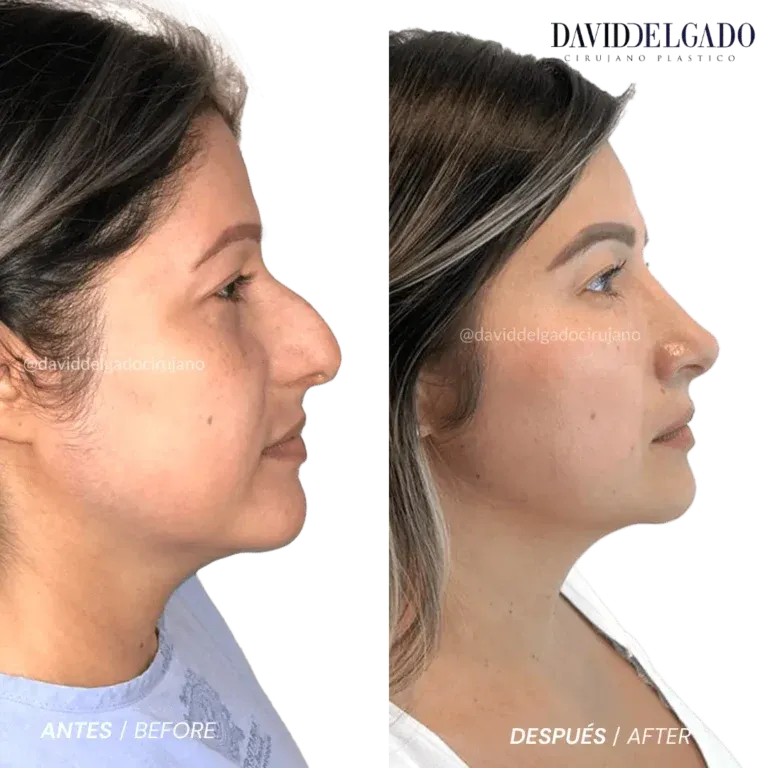 Before and after deep plane facelift — 45-year-old woman, frontal view by Dr. David Delgado