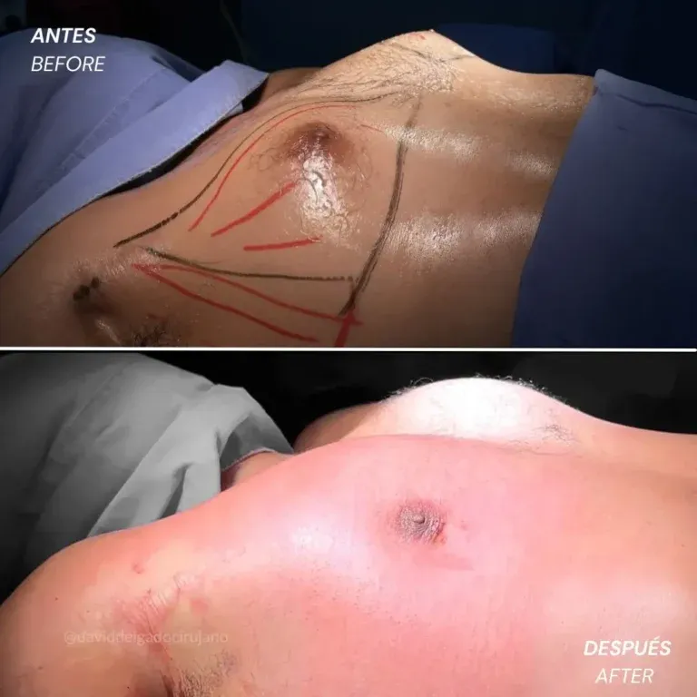 Before and after deep plane facelift — 45-year-old man, frontal view by Dr. David Delgado