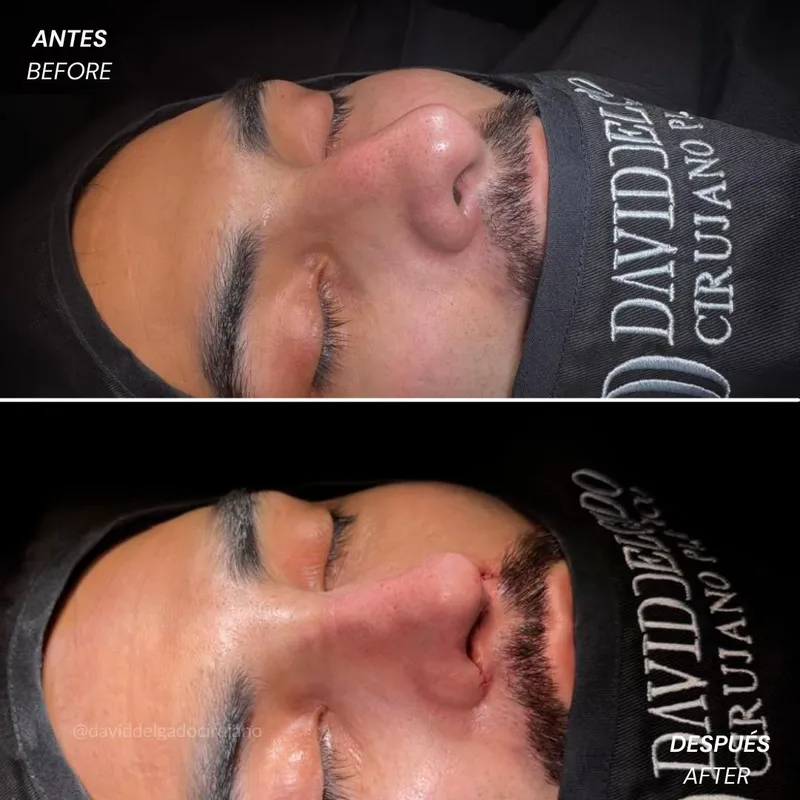 Before and after deep plane facelift — 35-year-old man, frontal view by Dr. David Delgado