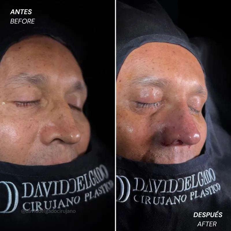 Before and after deep plane facelift — 55-year-old man, frontal view by Dr. David Delgado