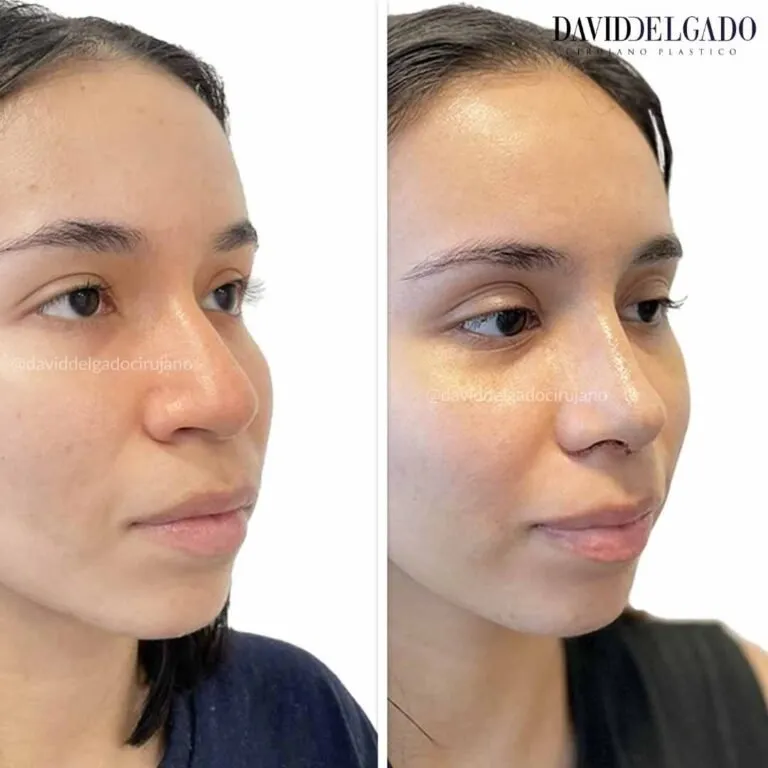 Before and after deep plane facelift — 28-year-old woman, frontal view by Dr. David Delgado