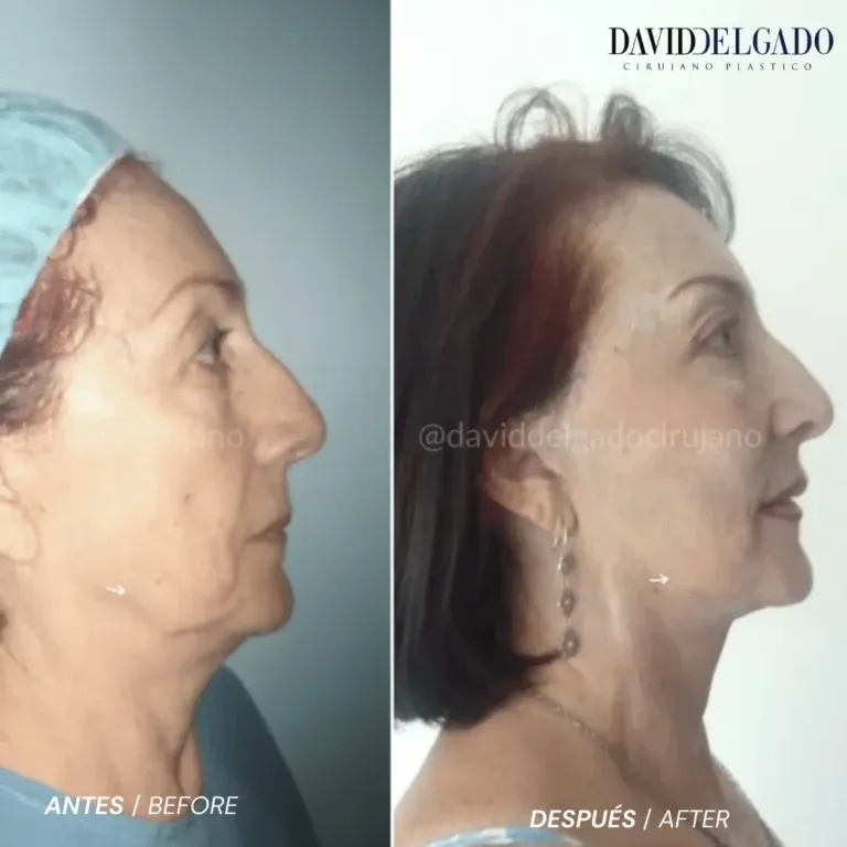 Before and after deep plane facelift — 58-year-old woman, frontal view by Dr. David Delgado