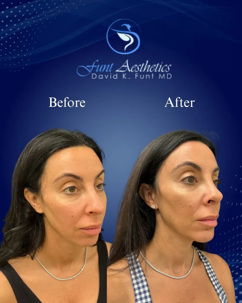 Before and after — Dr. David Funt