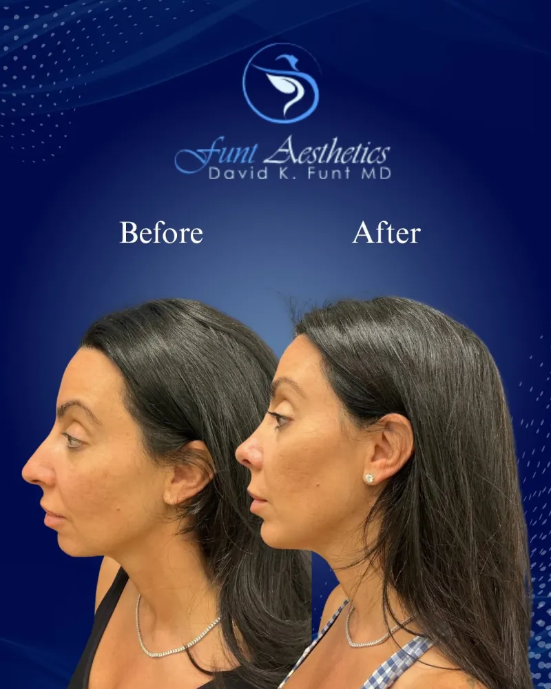 Before and after — Dr. David Funt