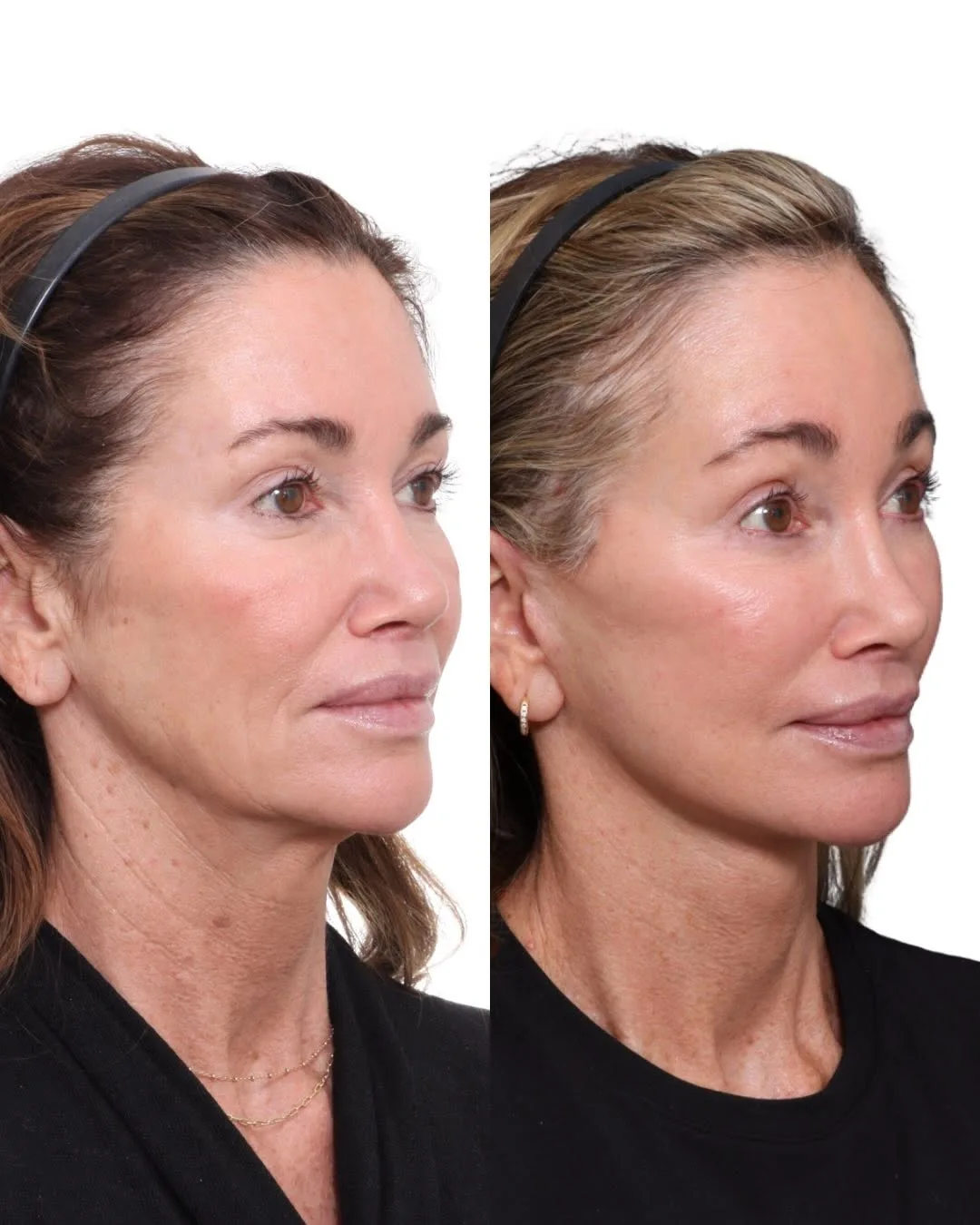 Before and after deep plane facelift — 52-year-old woman, three-quarter view, 3mo post-op by Dr. David Gilpin