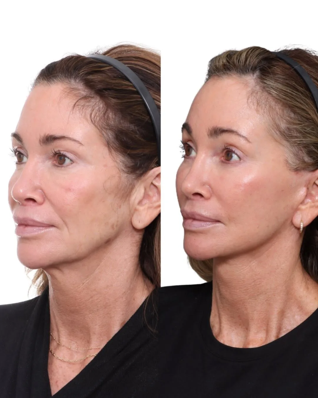 Before and after deep plane facelift — 52-year-old woman, three-quarter view, 3mo post-op by Dr. David Gilpin