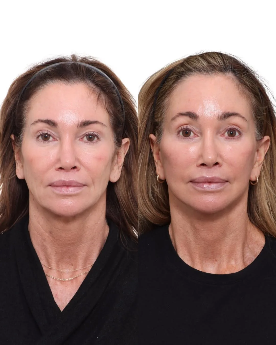 Before and after deep plane facelift — 52-year-old woman, frontal view, 3mo post-op by Dr. David Gilpin