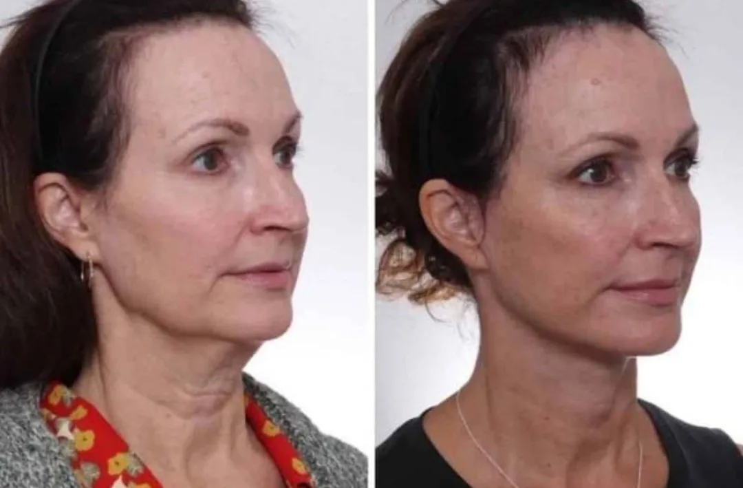 Before and after deep plane facelift — 52-year-old woman, left profile view, 6mo post-op by Dr. David Gilpin