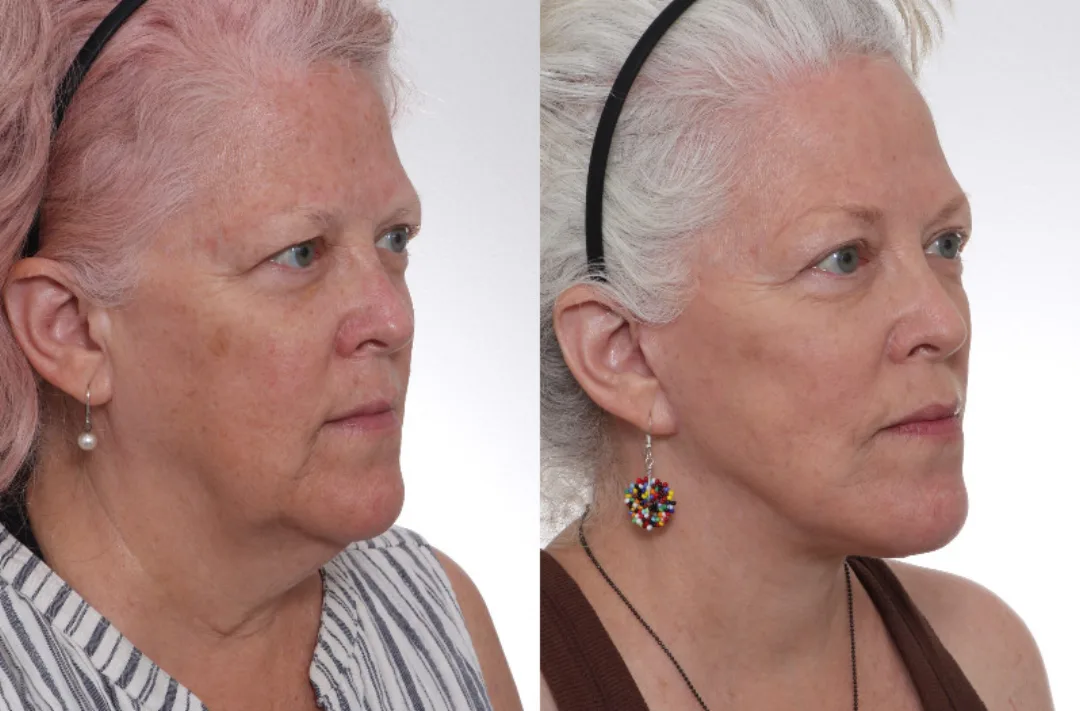 Before and after deep plane facelift — 65-year-old woman, oblique left view, 7mo post-op by Dr. David Gilpin