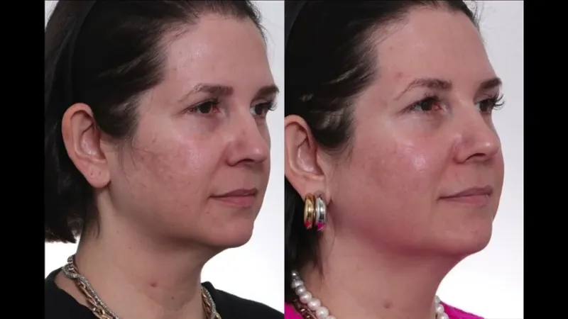 Before and after deep plane facelift, frontal view by Dr. David Gilpin