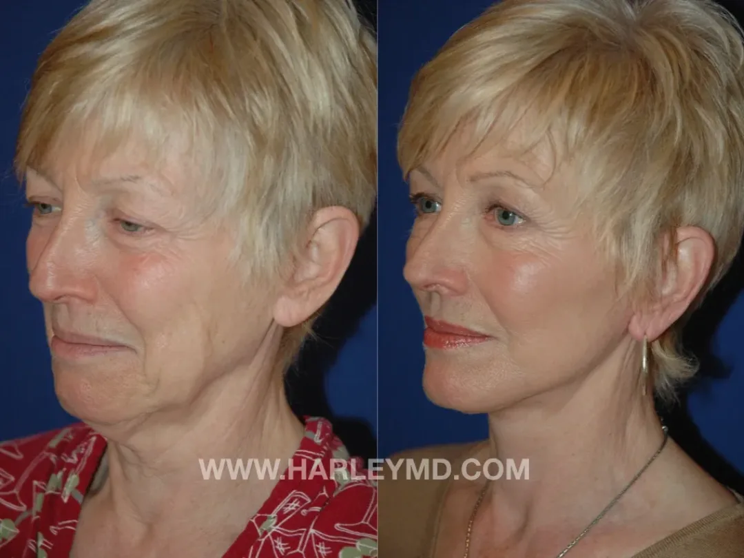 Before and after — Dr. David Harley