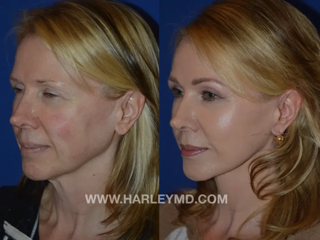 Before and after — Dr. David Harley