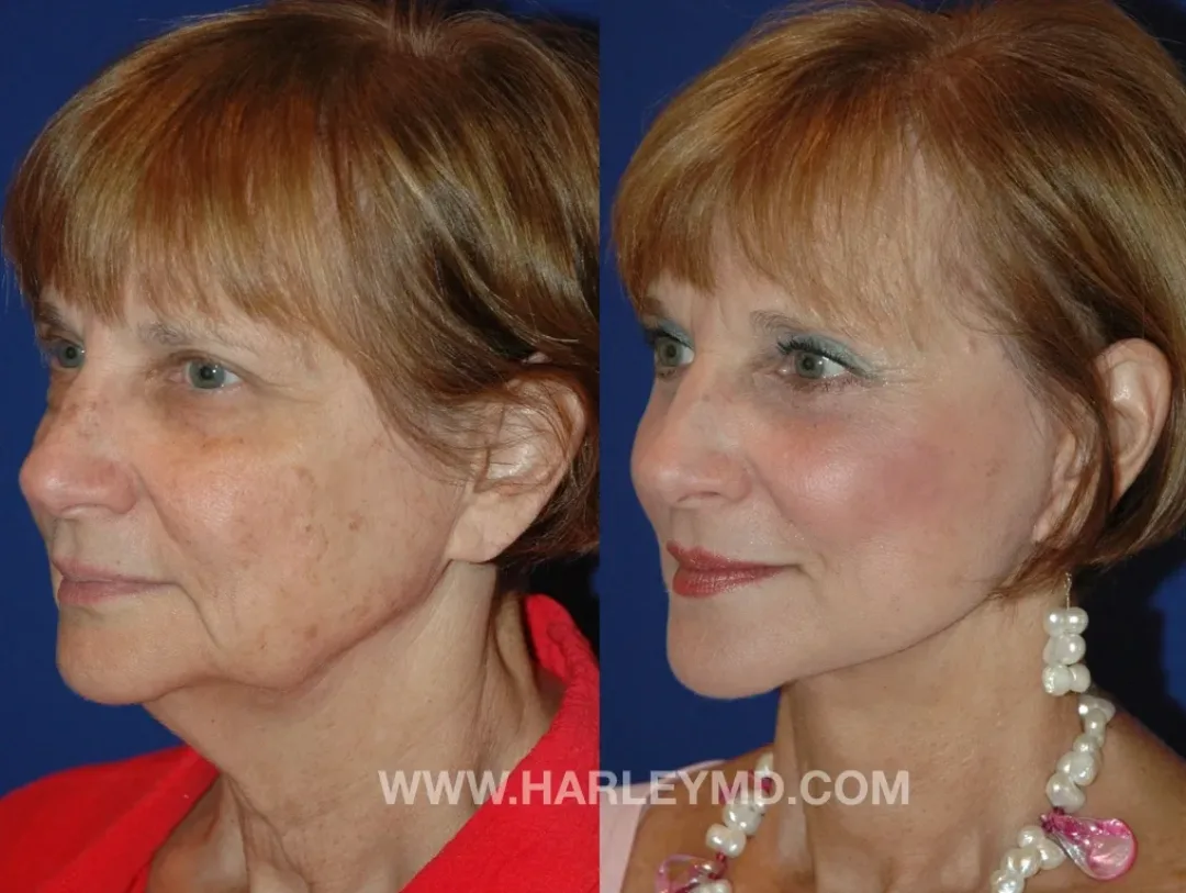 Before and after — Dr. David Harley