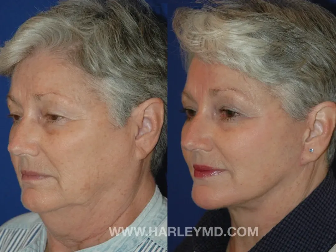 Before and after — Dr. David Harley