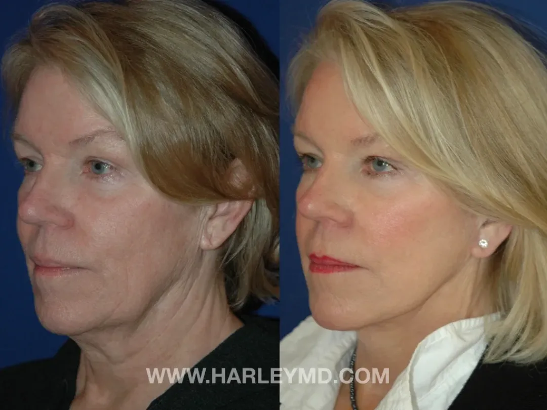 Before and after — Dr. David Harley