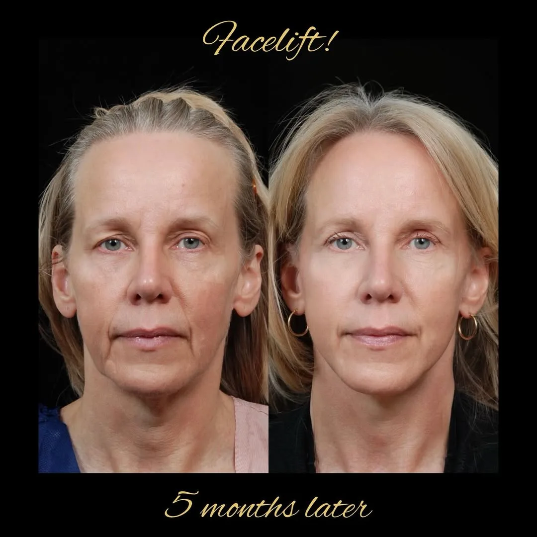 Before and after — Dr. David Hidalgo