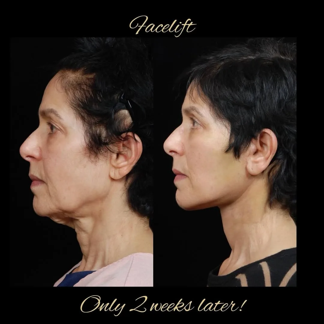 Before and after — Dr. David Hidalgo