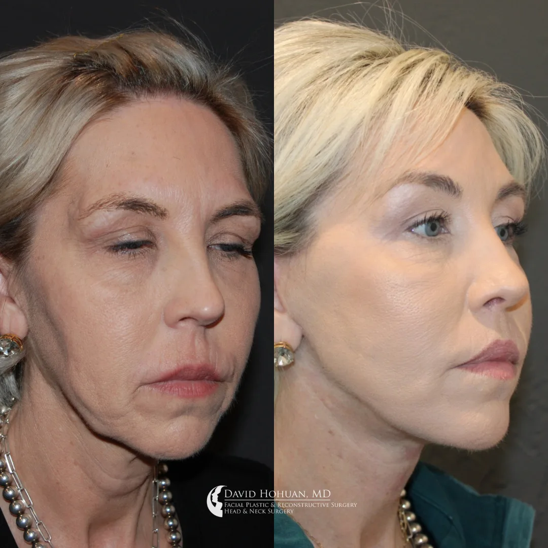 Before and after — Dr. David Ho Huan
