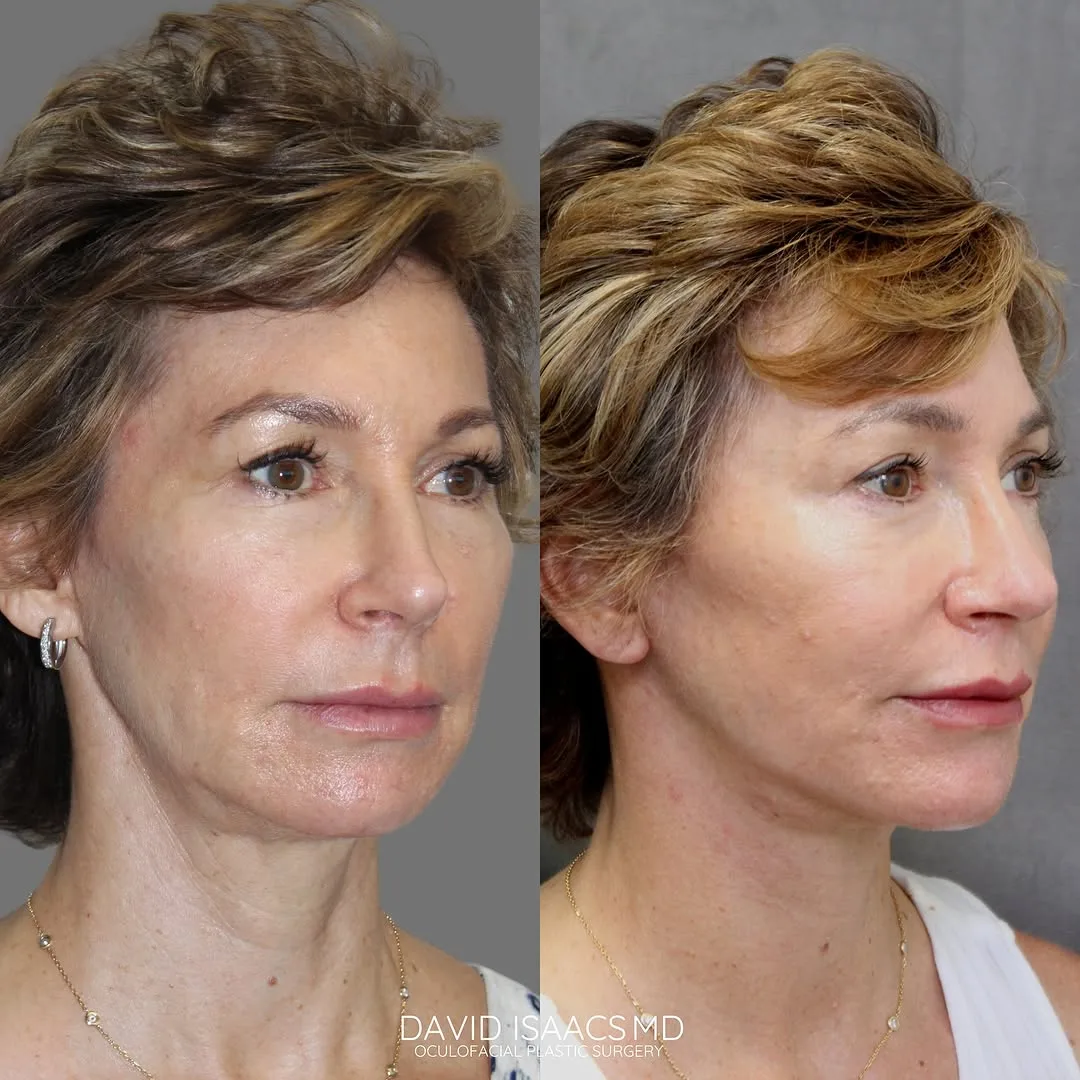 Before and after deep plane facelift — 58-year-old woman, three-quarter view, 6mo post-op by Dr. David Isaacs