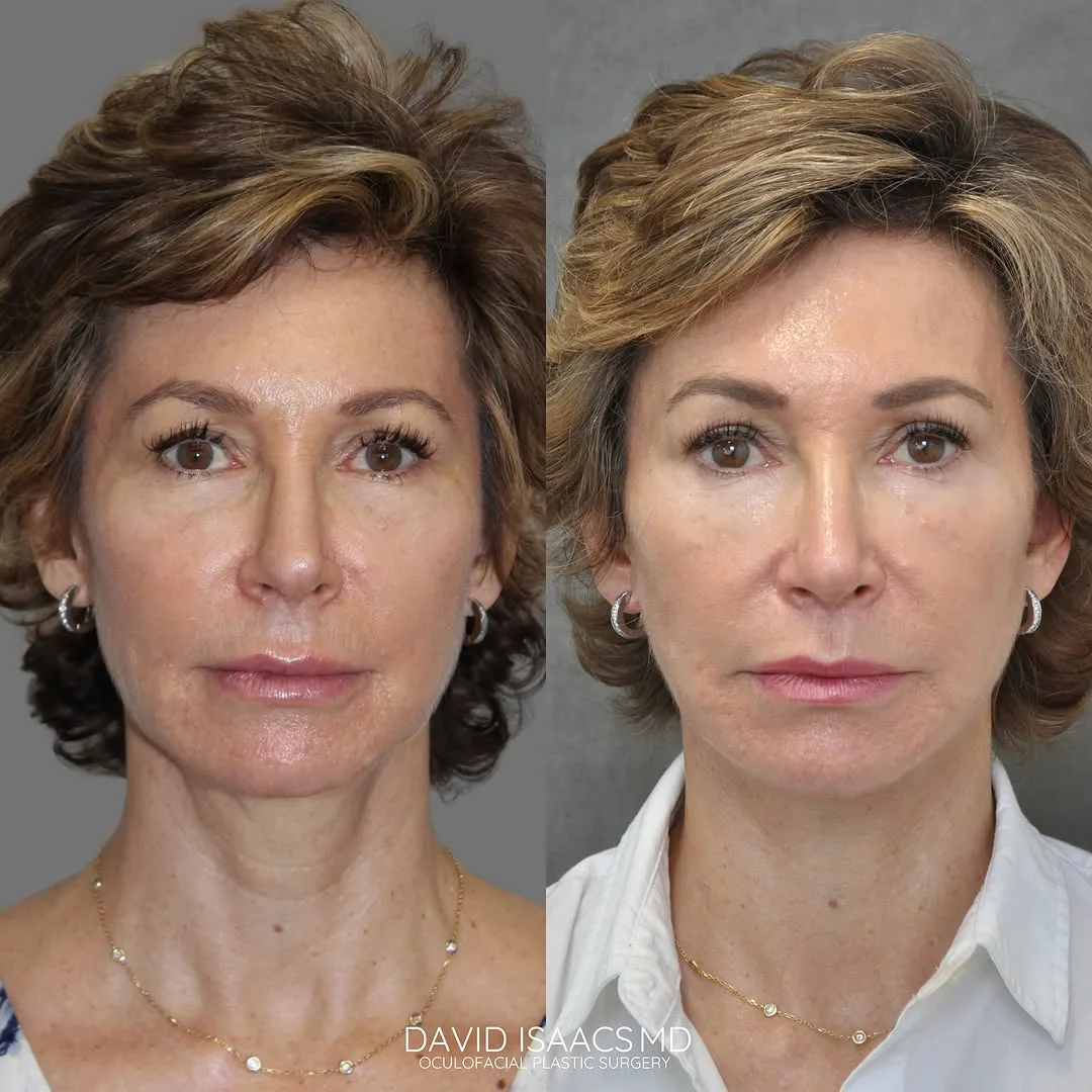 Before and after deep plane facelift — 55-year-old woman, frontal view, 7mo post-op by Dr. David Isaacs