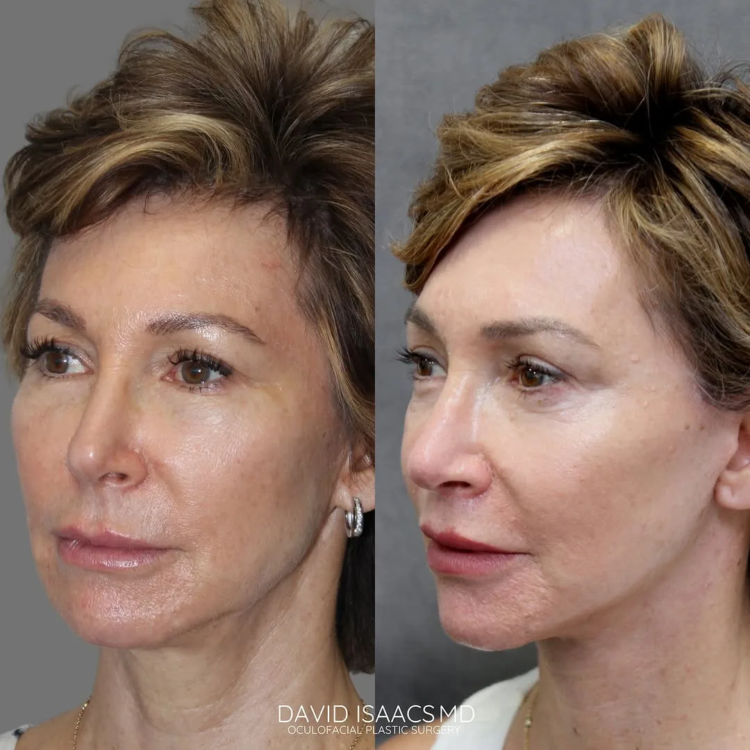 Before and after deep plane facelift — 55-year-old woman, oblique right view, 7mo post-op by Dr. David Isaacs
